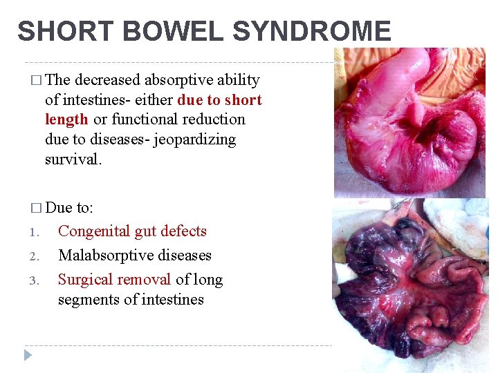 SHORT BOWEL SYNDROME � The decreased absorptive ability of intestines- either due to short