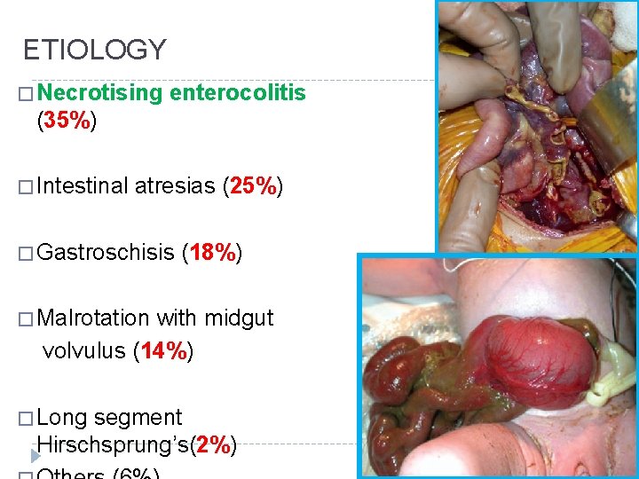 ETIOLOGY � Necrotising enterocolitis (35%) � Intestinal atresias (25%) � Gastroschisis (18%) � Malrotation