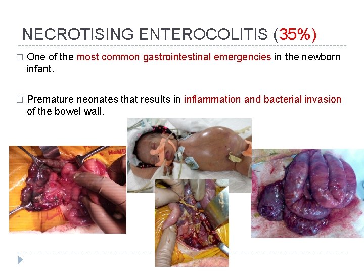 NECROTISING ENTEROCOLITIS (35%) � One of the most common gastrointestinal emergencies in the newborn