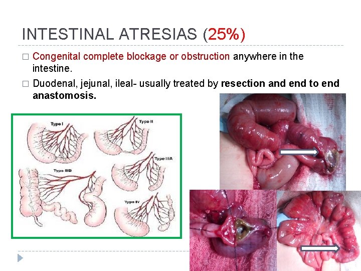 INTESTINAL ATRESIAS (25%) � Congenital complete blockage or obstruction anywhere in the intestine. �