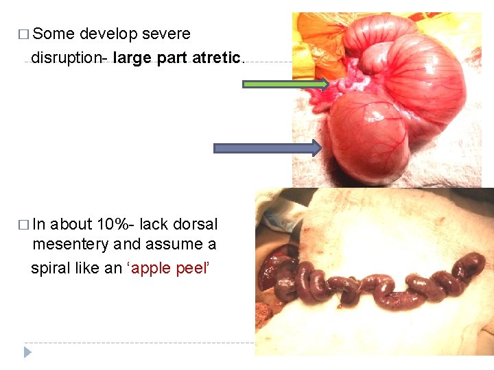 � Some develop severe disruption- large part atretic. � In about 10%- lack dorsal