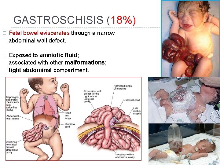 GASTROSCHISIS (18%) � Fetal bowel eviscerates through a narrow abdominal wall defect. � Exposed