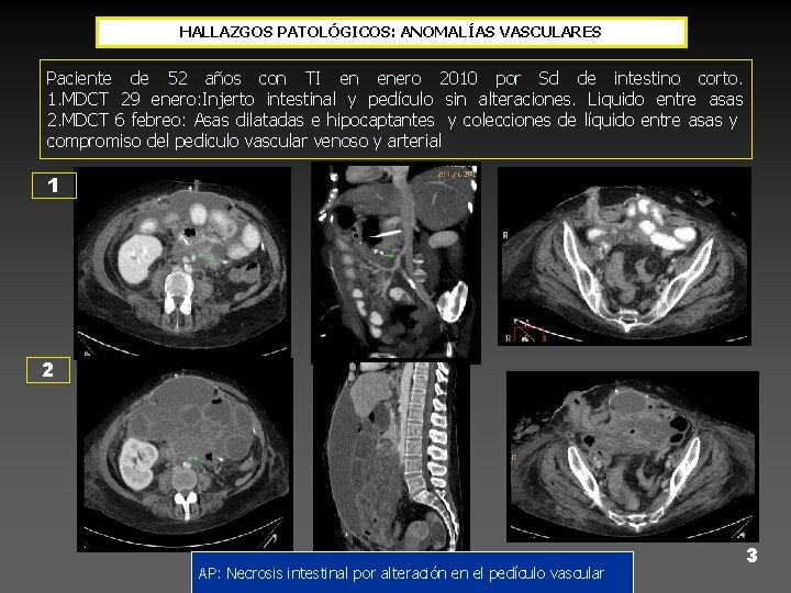 HALLAZGOS PATOLÓGICOS: ANOMALÍAS VASCULARES Paciente de 52 años con TI en enero 2010 por