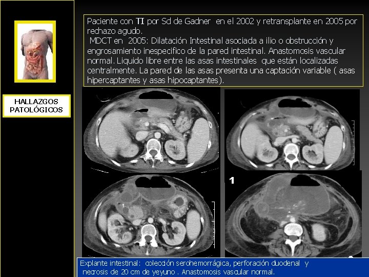 Paciente con TI por Sd de Gadner en el 2002 y retransplante en 2005