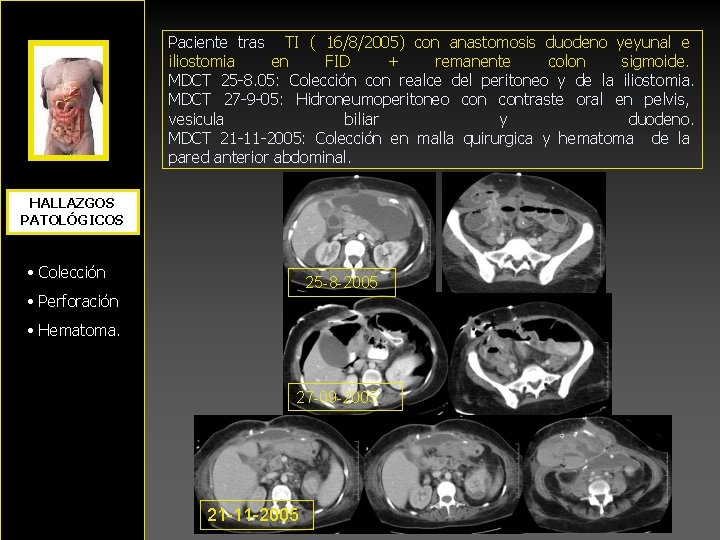 Paciente tras TI ( 16/8/2005) con anastomosis duodeno yeyunal e iliostomia en FID +