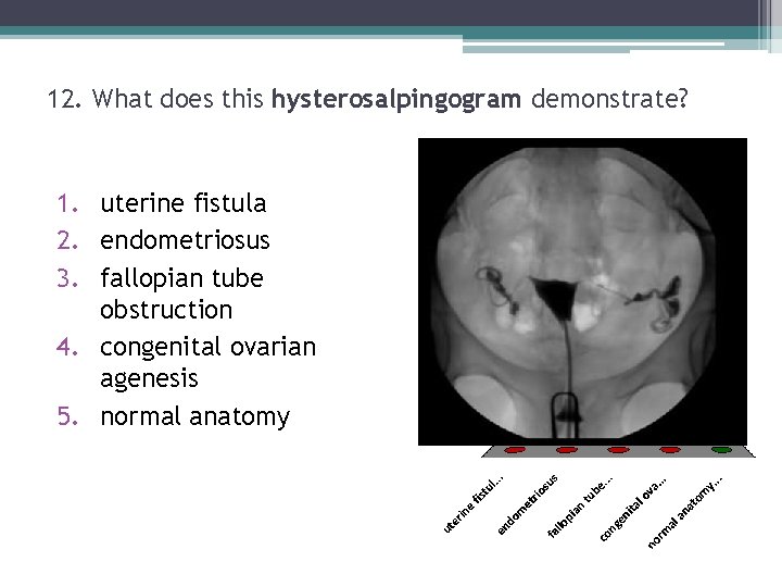 12. What does this hysterosalpingogram demonstrate? 1. uterine fistula 2. endometriosus 3. fallopian tube 12. What does this hysterosalpingogram demonstrate? 1. uterine fistula 2. endometriosus 3. fallopian tube