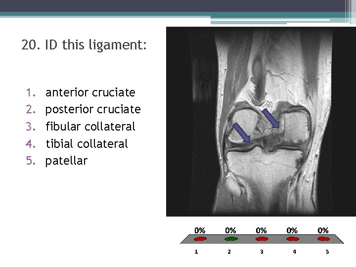 20. ID this ligament: 1. 2. 3. 4. 5. anterior cruciate posterior cruciate fibular 20. ID this ligament: 1. 2. 3. 4. 5. anterior cruciate posterior cruciate fibular
