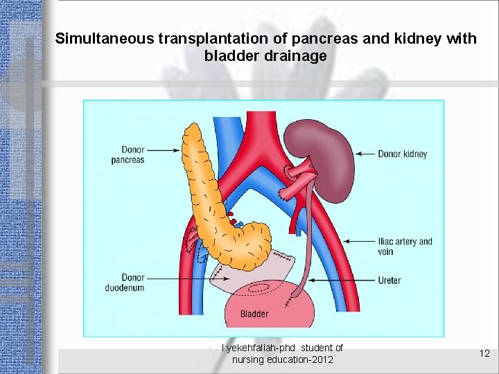 Simultaneous transplantation of pancreas and kidney with bladder drainage l. yekehfallah-phd student of nursing