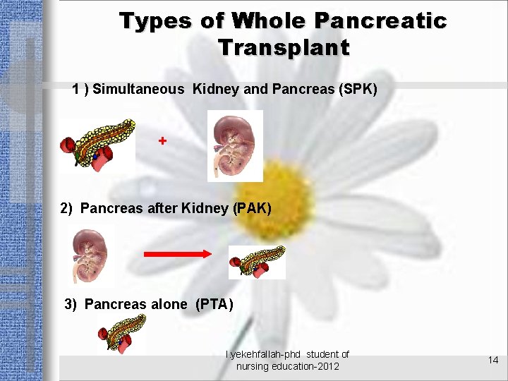 Types of Whole Pancreatic Transplant 1 ) Simultaneous Kidney and Pancreas (SPK) + 2)