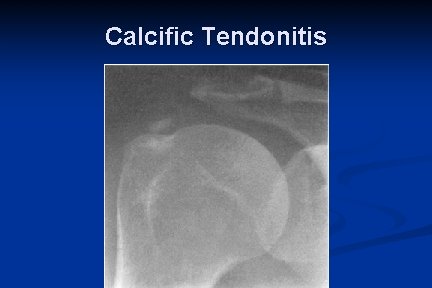 Calcific Tendonitis 