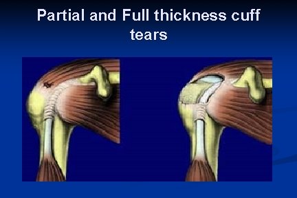 Partial and Full thickness cuff tears 