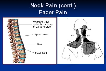 Neck Pain (cont. ) Facet Pain 