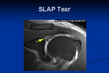 SLAP Tear 