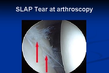 SLAP Tear at arthroscopy 
