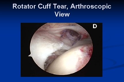 Rotator Cuff Tear, Arthroscopic View 