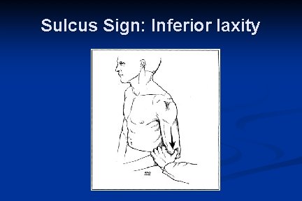 Sulcus Sign: Inferior laxity 