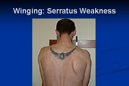Winging: Serratus Weakness 