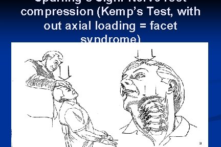 Spurling’s Sign: Nerve root compression (Kemp’s Test, with out axial loading = facet syndrome)