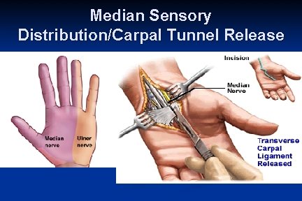 Median Sensory Distribution/Carpal Tunnel Release 