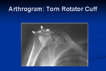 Arthrogram: Torn Rotator Cuff 