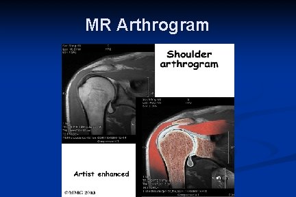 MR Arthrogram 