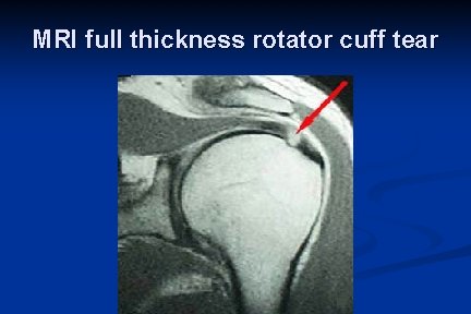 MRI full thickness rotator cuff tear 