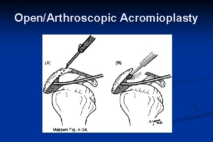 Open/Arthroscopic Acromioplasty 