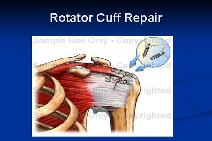 Rotator Cuff Repair 