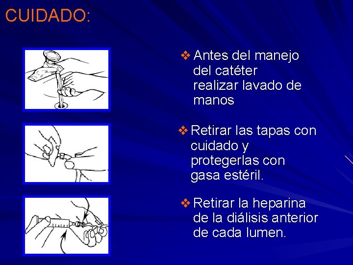 CUIDADO: v Antes del manejo del catéter realizar lavado de manos v Retirar las