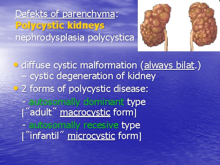 Defekts of parenchyma: Polycystic kidneys nephrodysplasia polycystica • diffuse cystic malformation (always bilat. )