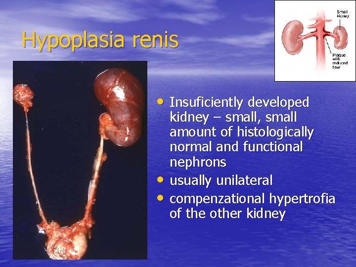 Hypoplasia renis • Insuficiently developed • • kidney – small, small amount of histologically