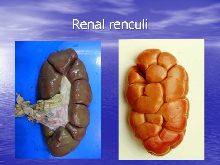 Renal renculi 