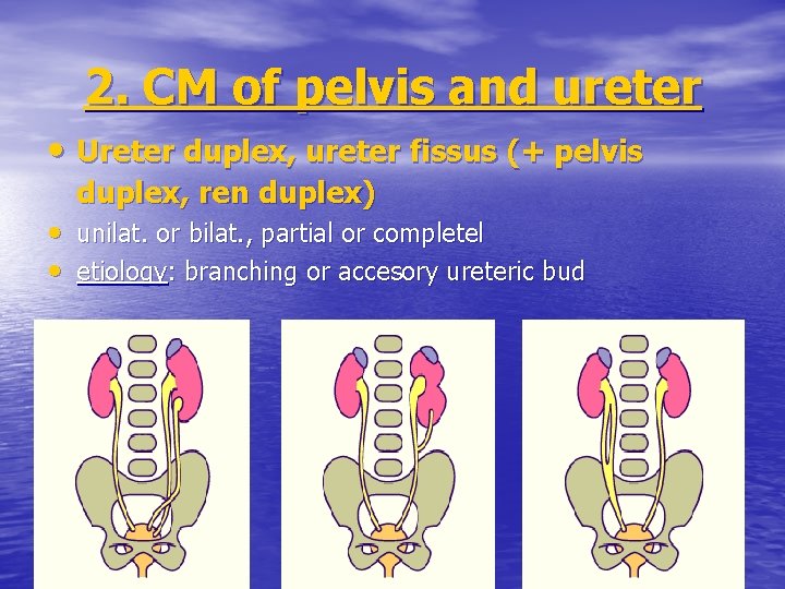 2. CM of pelvis and ureter • Ureter duplex, ureter fissus (+ pelvis duplex,