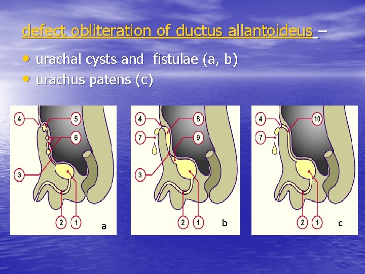 defect obliteration of ductus allantoideus – • urachal cysts and fistulae (a, b) •