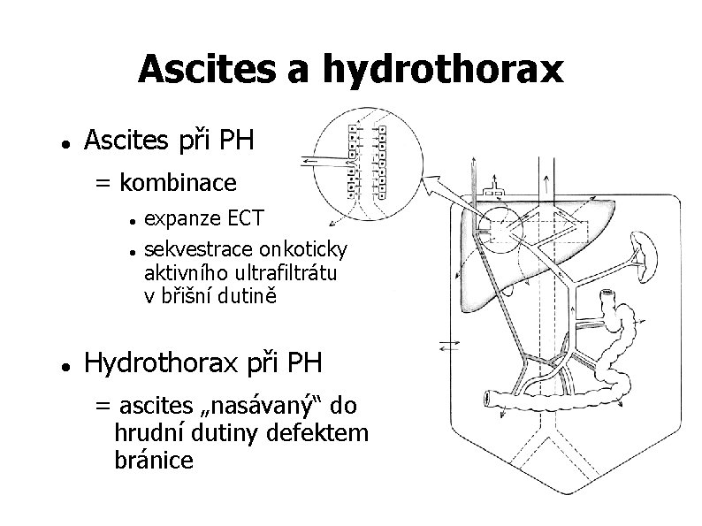 Ascites a hydrothorax Ascites při PH = kombinace expanze ECT sekvestrace onkoticky aktivního ultrafiltrátu