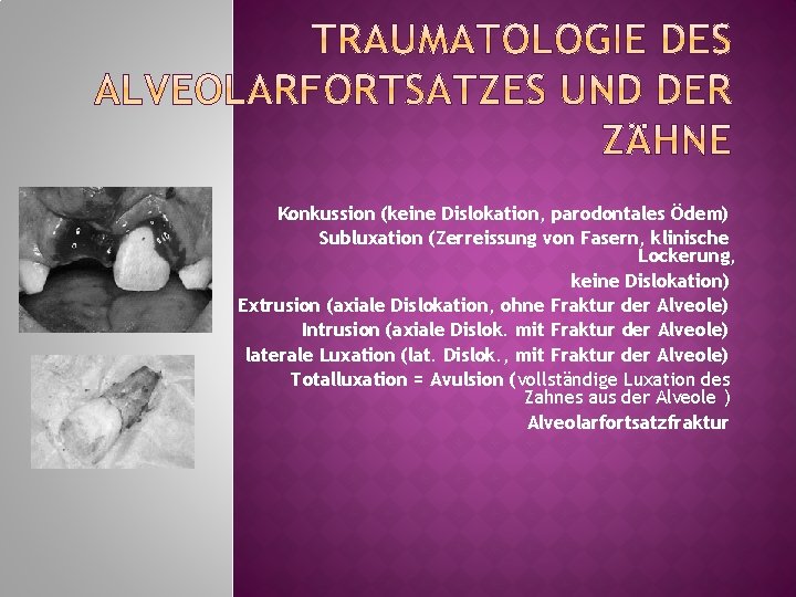Konkussion (keine Dislokation, parodontales Ödem) Subluxation (Zerreissung von Fasern, klinische Lockerung, keine Dislokation) Extrusion