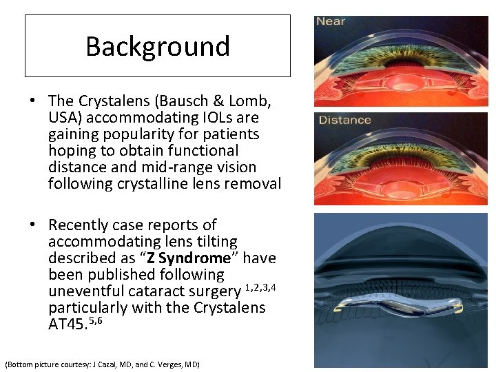 Background • The Crystalens (Bausch & Lomb, USA) accommodating IOLs are gaining popularity for