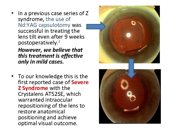  • In a previous case series of Z syndrome, the use of Nd: