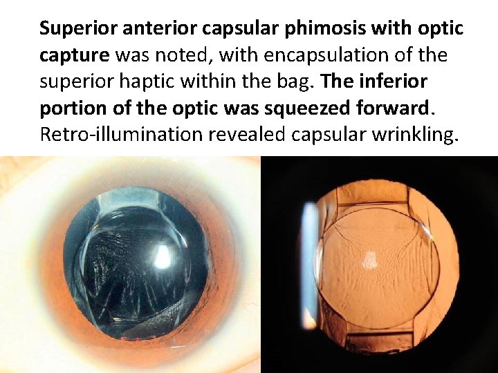 Superior anterior capsular phimosis with optic capture was noted, with encapsulation of the superior