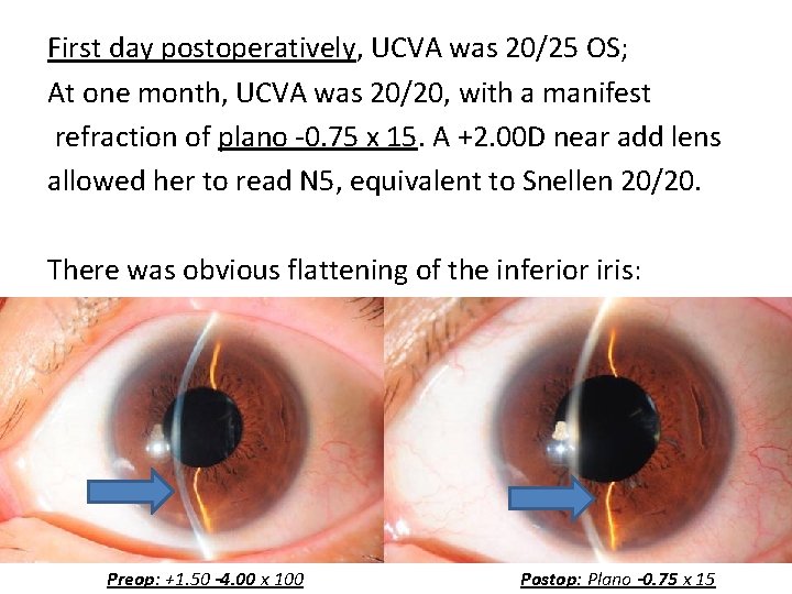 First day postoperatively, UCVA was 20/25 OS; At one month, UCVA was 20/20, with