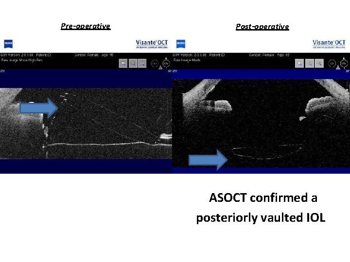 Pre-operative Post-operative ASOCT confirmed a posteriorly vaulted IOL 