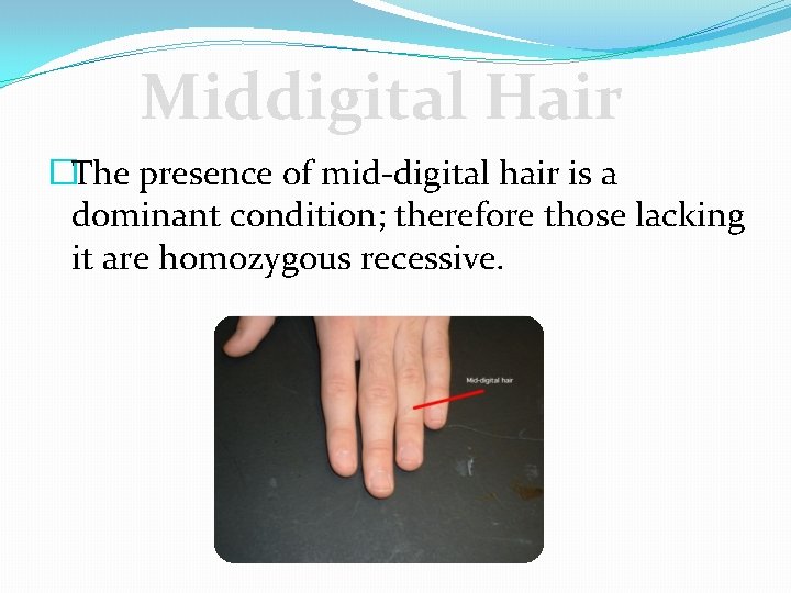 Middigital Hair �The presence of mid-digital hair is a dominant condition; therefore those lacking