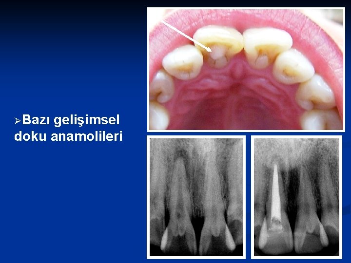 ØBazı gelişimsel doku anamolileri 