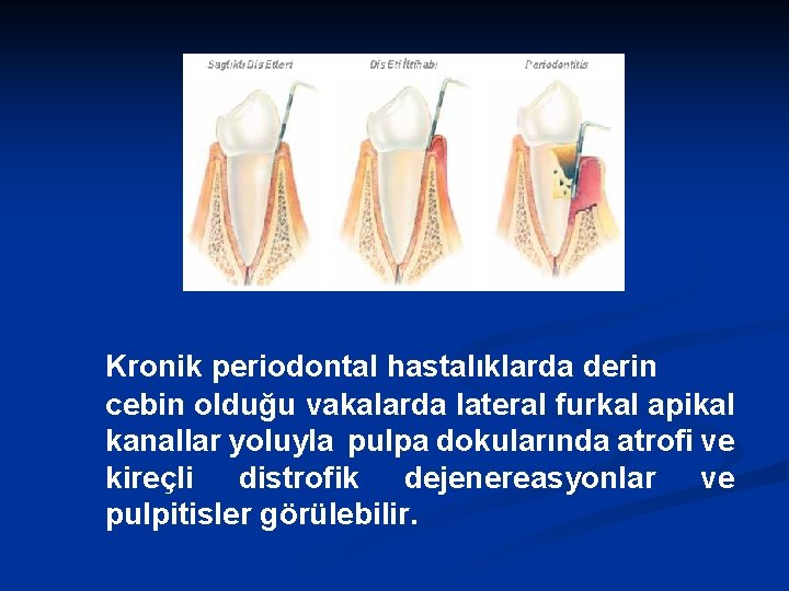 Kronik periodontal hastalıklarda derin cebin olduğu vakalarda lateral furkal apikal kanallar yoluyla pulpa dokularında