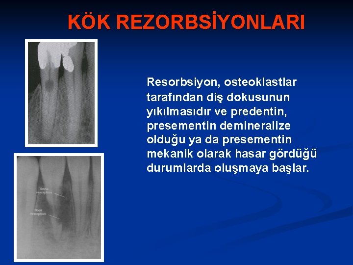 KÖK REZORBSİYONLARI Resorbsiyon, osteoklastlar tarafından diş dokusunun yıkılmasıdır ve predentin, presementin demineralize olduğu ya