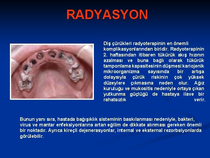 RADYASYON Diş çürükleri radyoterapinin en önemli komplikasyonlarından biridir. Radyoterapinin 2. haftasından itibaren tükürük akış