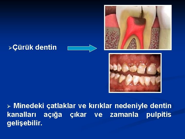 ØÇürük dentin Minedeki çatlaklar ve kırıklar nedeniyle dentin kanalları açığa çıkar ve zamanla pulpitis