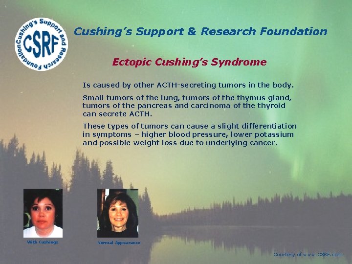Cushing’s Support & Research Foundation Ectopic Cushing’s Syndrome Is caused by other ACTH-secreting tumors Cushing’s Support & Research Foundation Ectopic Cushing’s Syndrome Is caused by other ACTH-secreting tumors