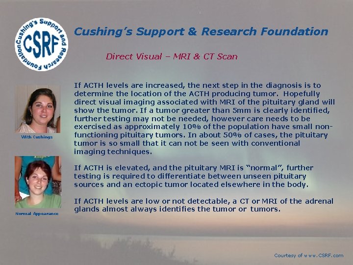 Cushing’s Support & Research Foundation Direct Visual – MRI & CT Scan With Cushings Cushing’s Support & Research Foundation Direct Visual – MRI & CT Scan With Cushings