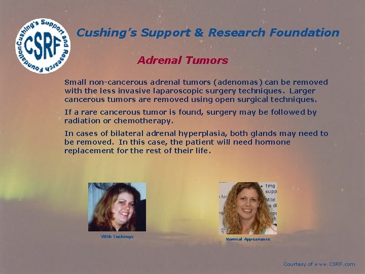 Cushing’s Support & Research Foundation Adrenal Tumors Small non-cancerous adrenal tumors (adenomas) can be Cushing’s Support & Research Foundation Adrenal Tumors Small non-cancerous adrenal tumors (adenomas) can be